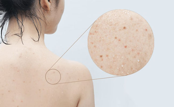 Nguyên nhân khiến mụn lưng phát triển dai dẳng trên da và cách khắc phục hiệu quả