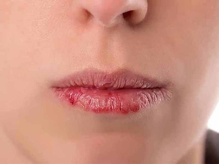 Chàm môi là bệnh lý gì?